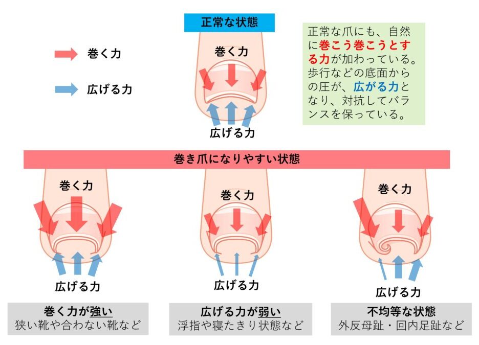 巻き爪の原因と予防 セルフケア 公式 専門医と学ぶ 巻き爪 陥入爪治療の相談室