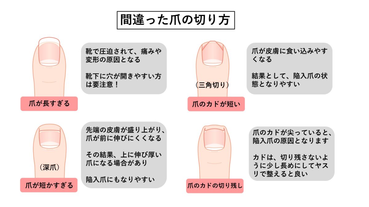 巻き爪の原因と予防 セルフケア 公式 専門医と学ぶ 巻き爪 陥入爪治療の相談室