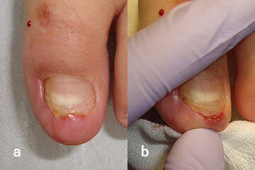 Gutter法（ガター法）による治療 ab 趾先の陥入爪