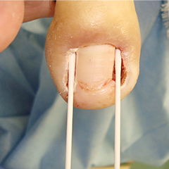 巻き爪手術の経過について 術中の状態
