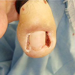巻き爪手術の経過について 術直後の状態