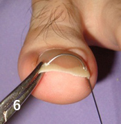 モスキート鉗子などで、片側のワイヤー位置を固定し、ワイヤーが爪甲彎曲に沿うようにしっかりと入れ込む