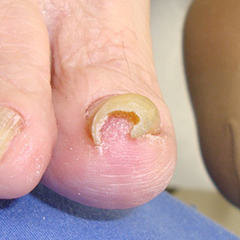 爪甲剥削法 a 高度な陥入爪に対して爪甲剥削術施行