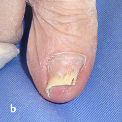 爪甲剥削法 b 施行直後：爪の彎曲が改善している