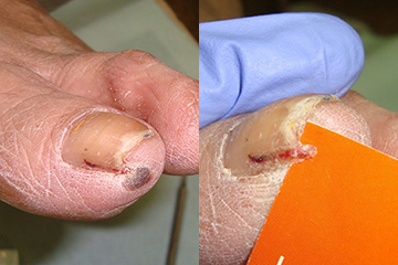 爪甲部分（爪棘）切除による治療治療