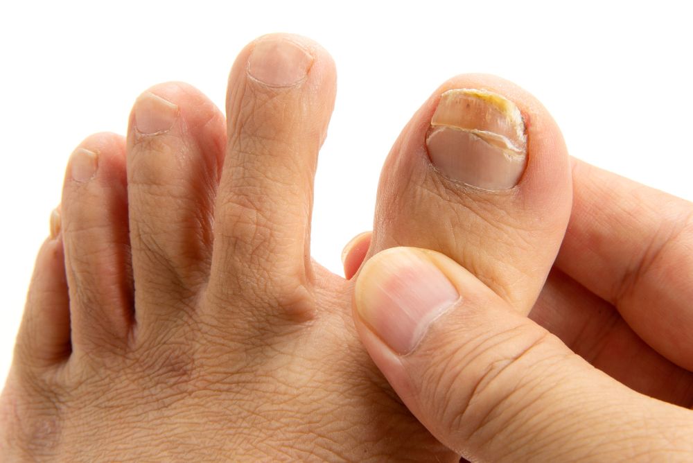 爪白癬（爪水虫）の足の爪