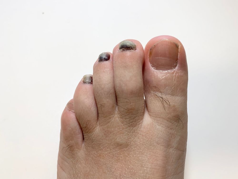 足の爪が黒い原因