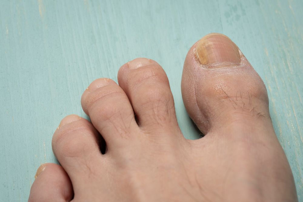 深爪の足の爪