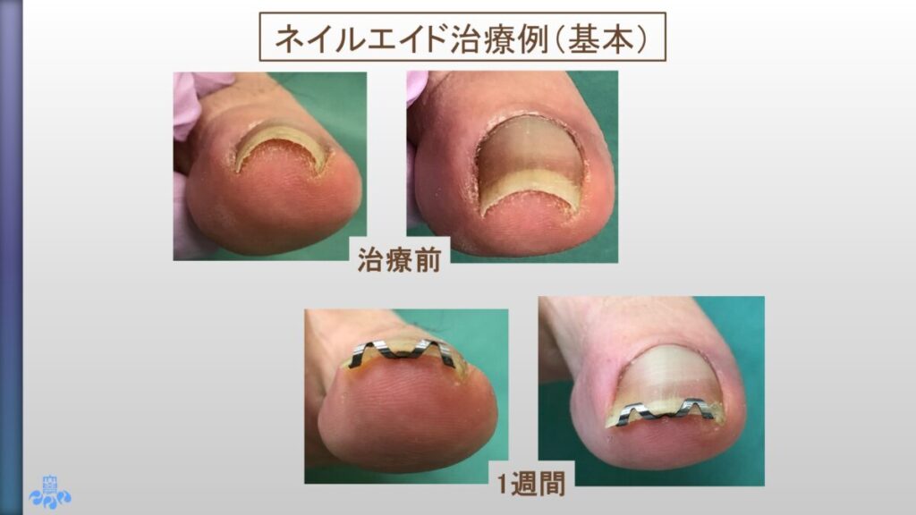 ネイルエイド使用例１