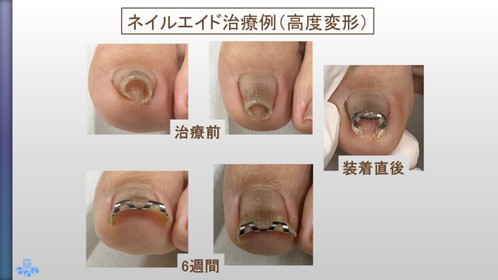 ネイルエイド使用例２