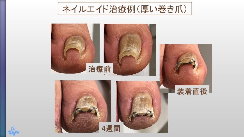 ネイルエイド使用例３