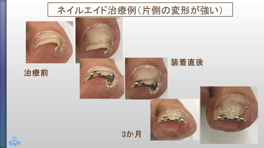 ネイルエイド使用例４