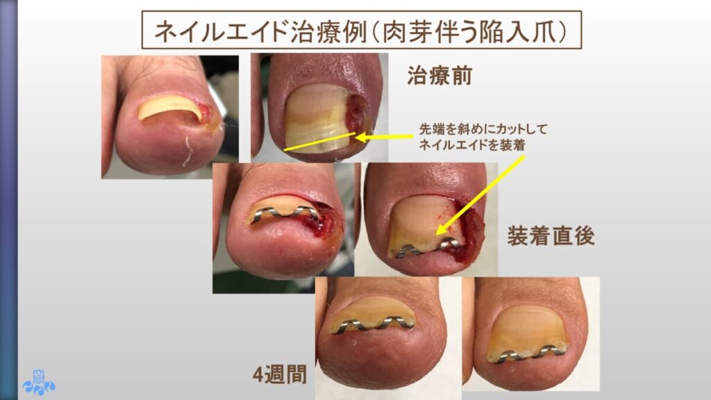 ネイルエイド使用例５