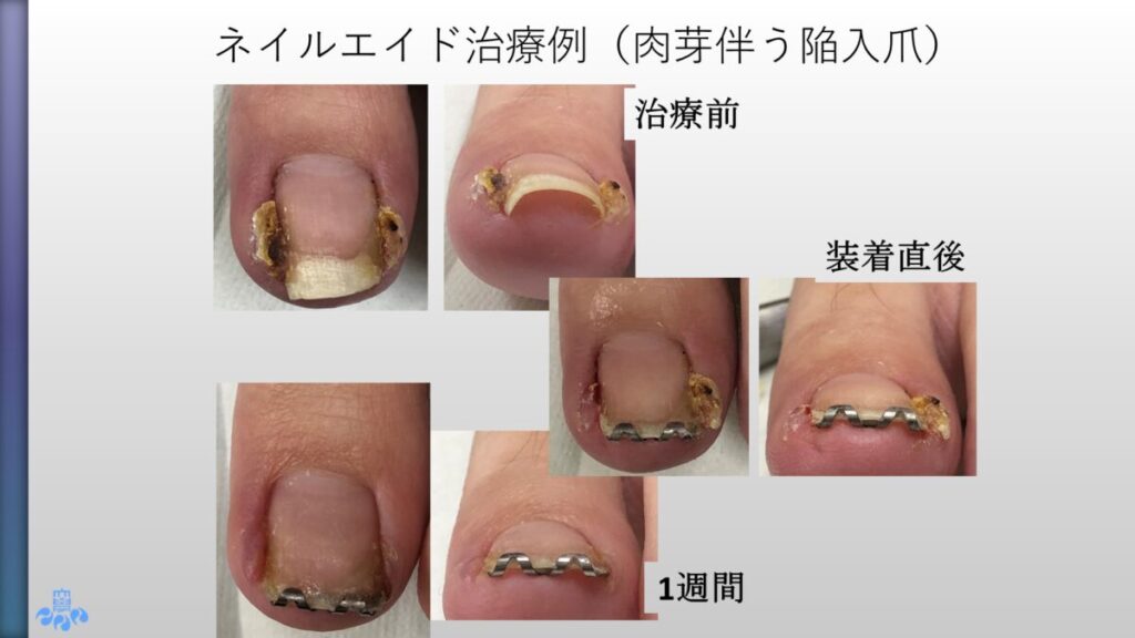 ネイルエイド使用例６」